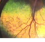 plis retiniens